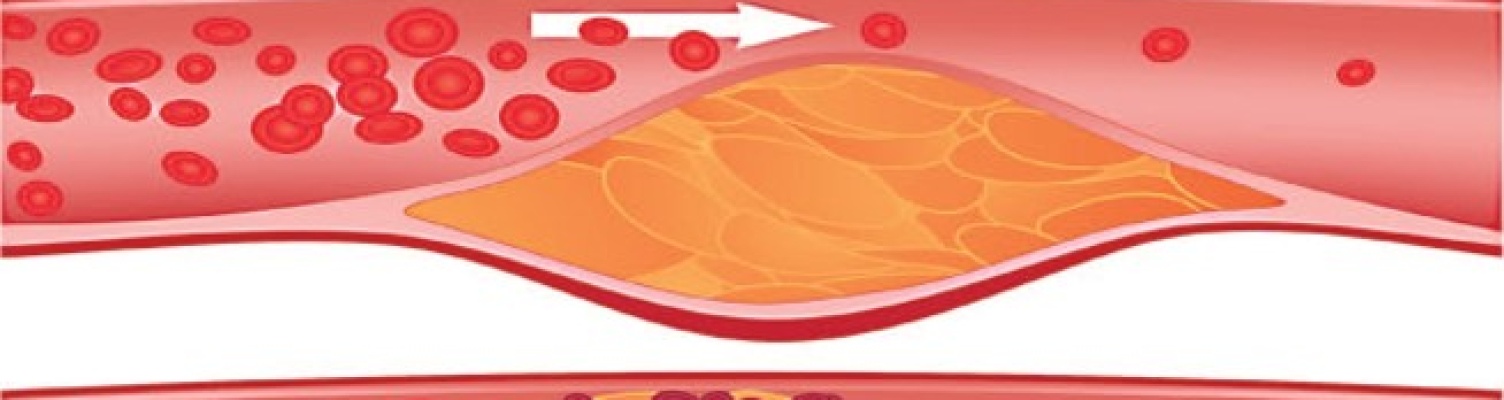 Как без статинов понизить холестерин и победить атеросклероз
